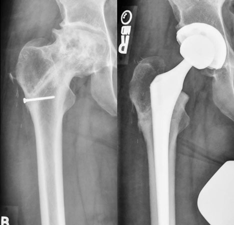 Before and after THR X-rays