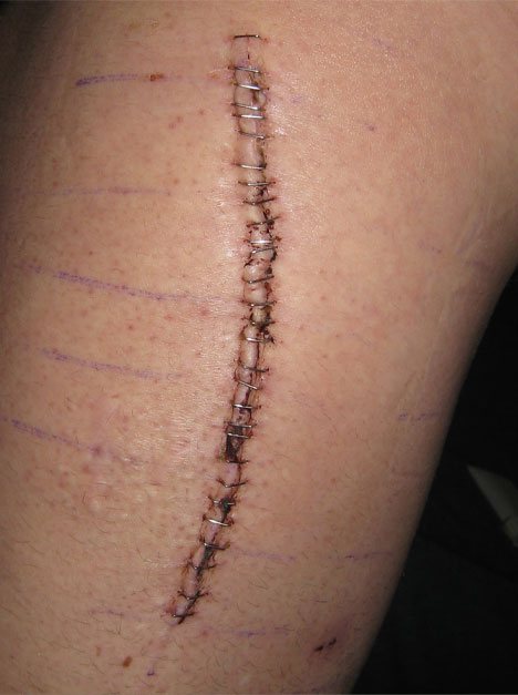 THR incision photo